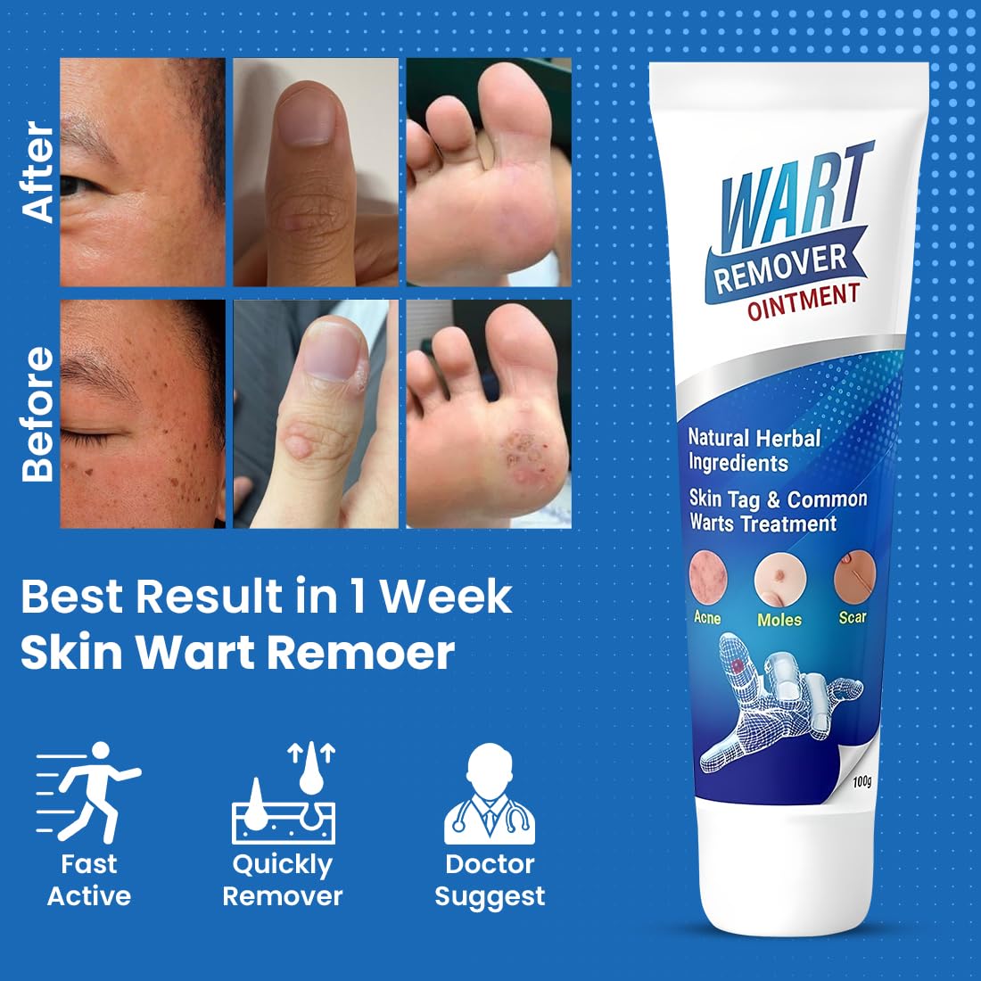 Wart Remover (Pack of 1)