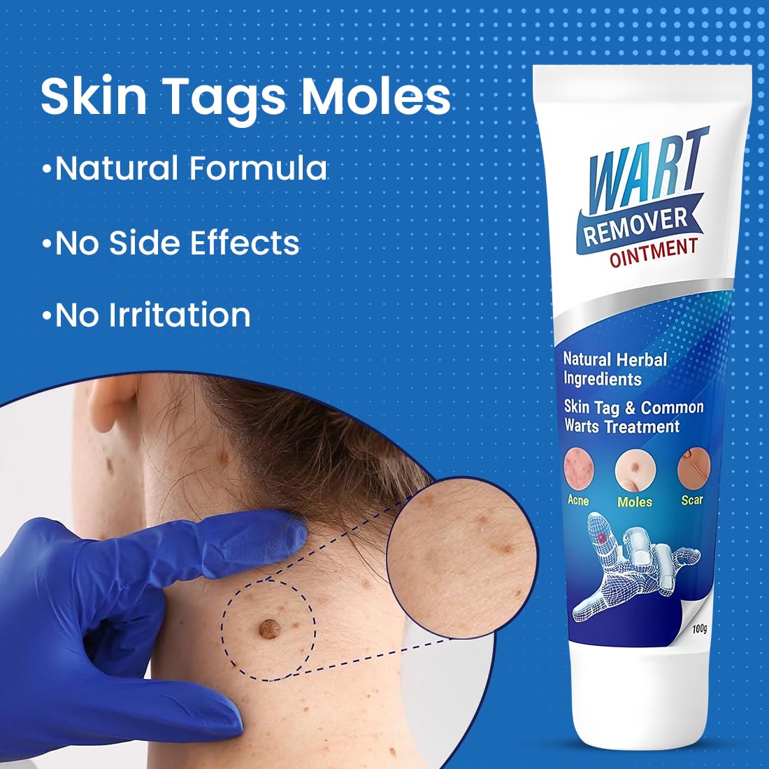 Wart Remover (Pack of 1)