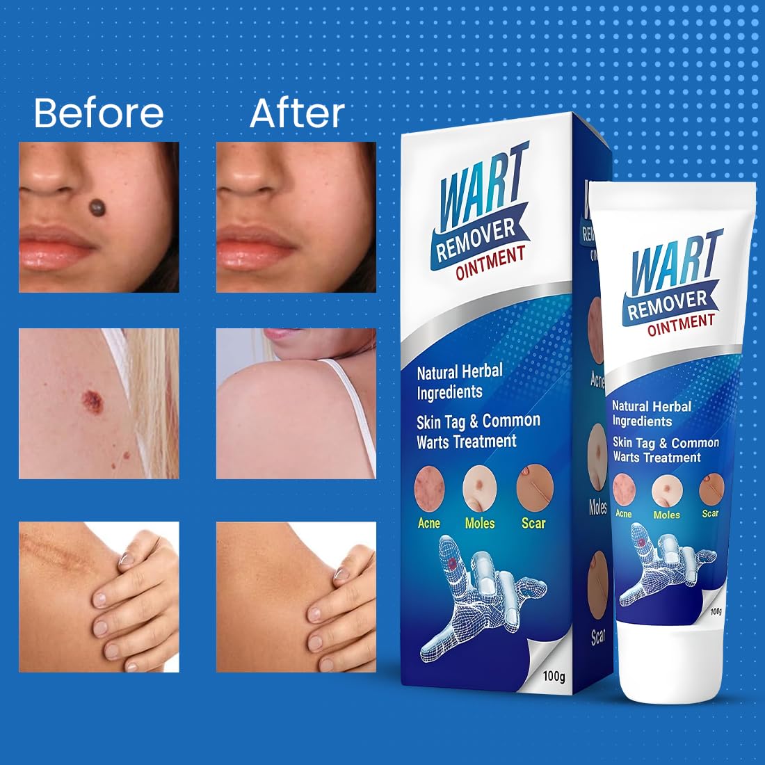 Wart Remover (Pack of 1)