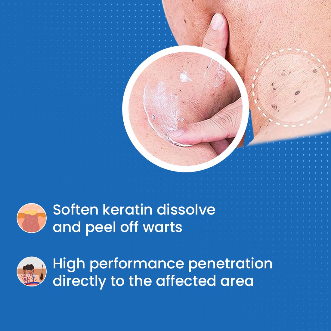 Wart Remover (Pack of 1)