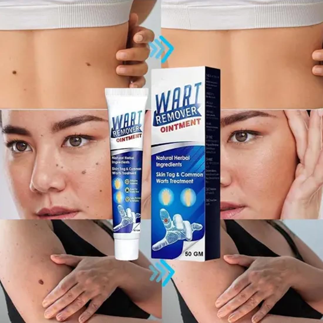 Wart Remover (Pack of 1)